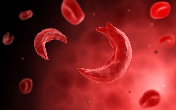 Sickle Cell Anemia: Symptoms and Treatment
